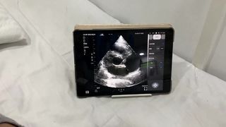 Sonde à ultrasons sans fil à double tête pour cardiaque et POCUS