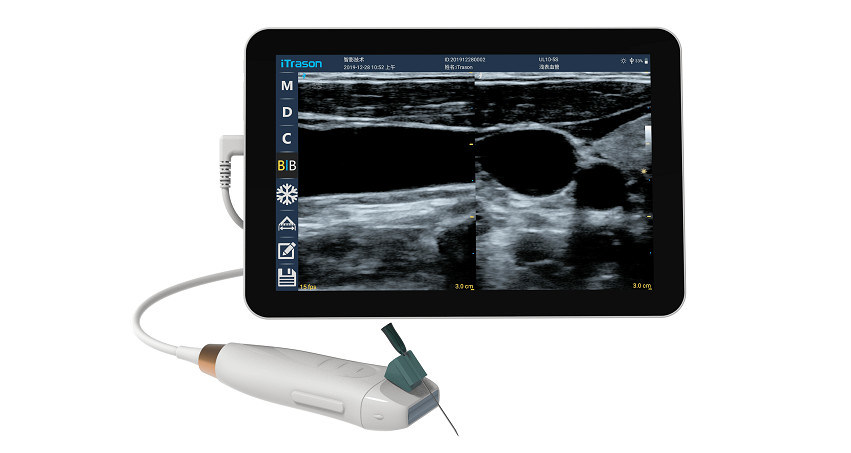 Scanner à ultrasons portable avec sonde linéaire haute fréquence 12 MHz pour un accès vasculaire précis et des procédures d'insertion PICC